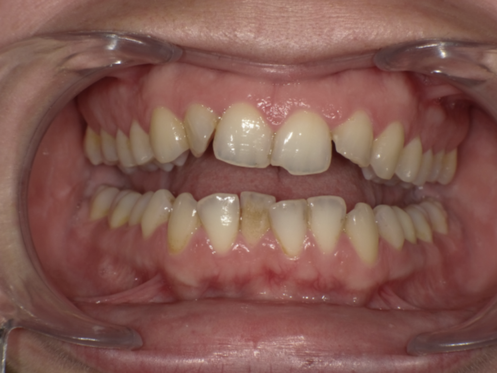 encombrement bas et dent grise orthodontiste dr antoine gourdin avant ouvert